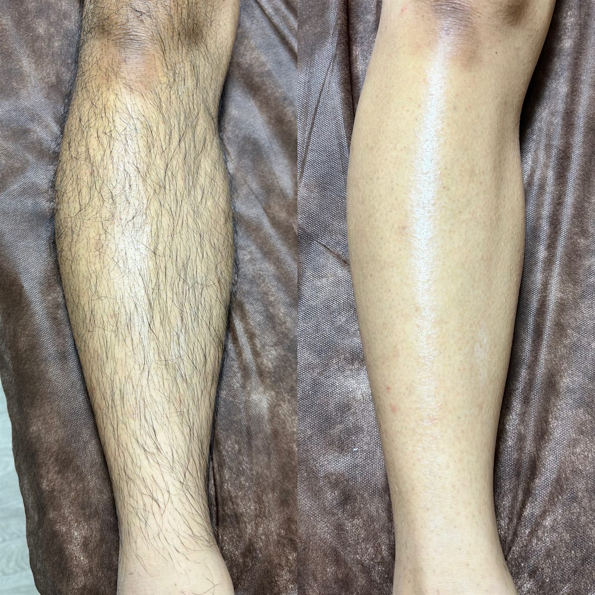 膝下のワックス脱毛の施術前後の比較写真。左が施術前、右が施術後