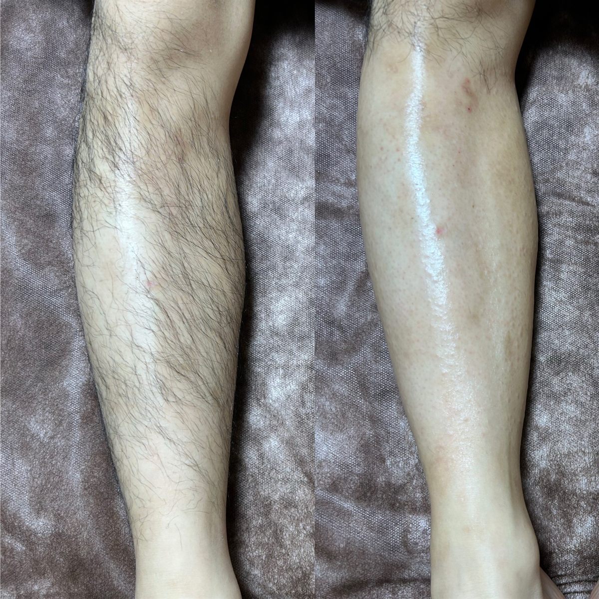 膝下のワックス脱毛の施術前後の比較写真。左が施術前、右が施術後