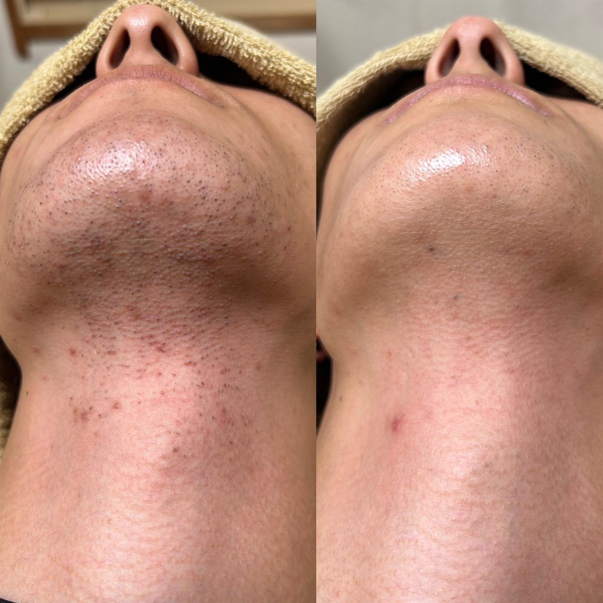 ヒゲの光脱毛の施術前後の比較写真。左が施術前、右が光照射2回後