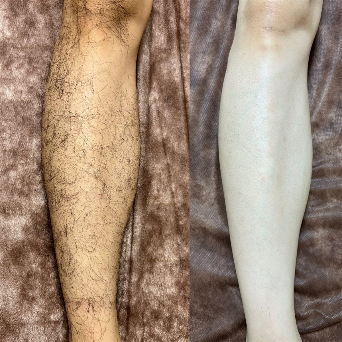 膝下の光脱毛の施術前後の比較写真。左が施術前、右が光照射11回後